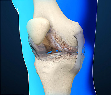 OSTEOARTHRITIS