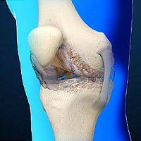 OSTEOARTHRITIS